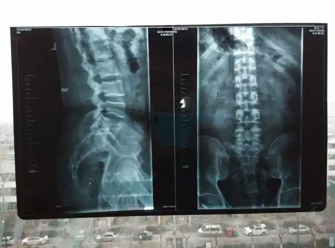 请医生帮我看看我的腰椎有什么毛病?