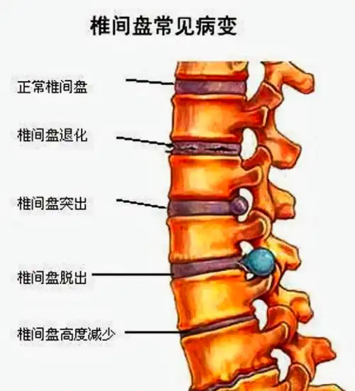 脊柱疾病反射图和对应分布歌诀