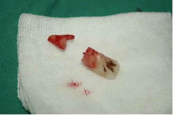 门牙磕掉一块补一补要多少钱