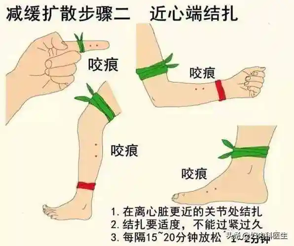 不幸被毒蛇咬伤该怎么办?医生一文告诉你如何自救