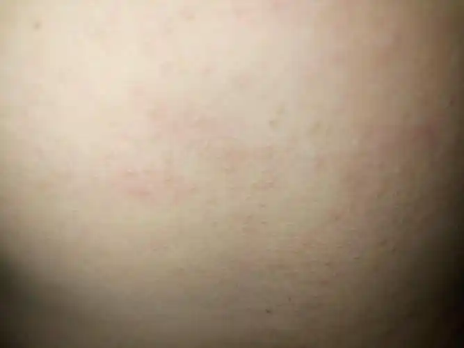 为什么我的肚子上会有很多这样的水泡,而且一抓就会变白.