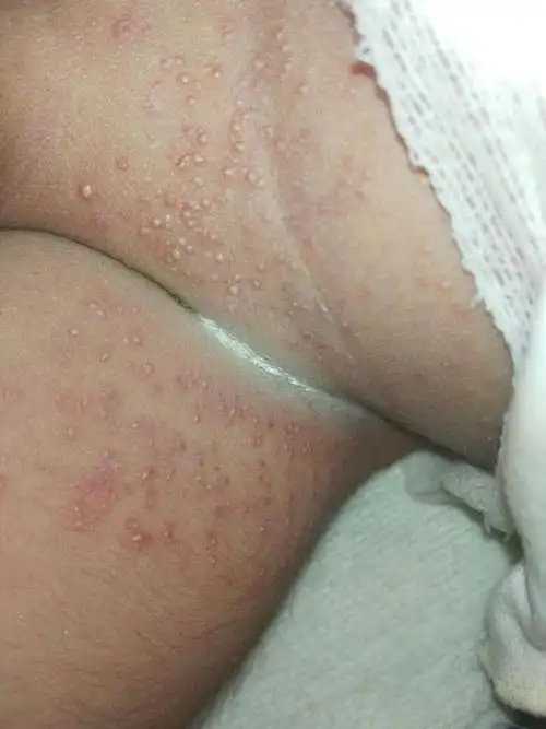 婴儿肛周湿疹图片_有来医生