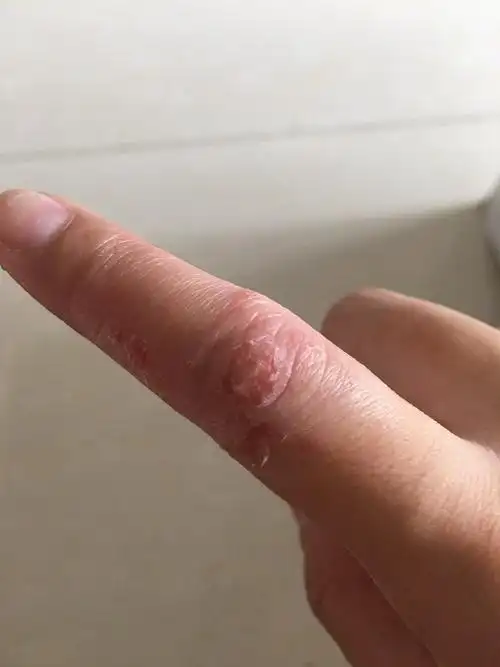 症状是水疱,痒,水疱破后有水样液体渗出,然后局部皮肤皴裂.