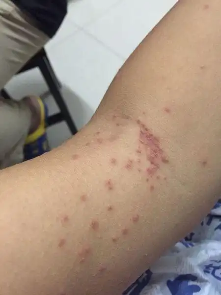 前几天盖了件旧被子,身上被螨虫咬了,也涂了药膏,两天了,身上红疹子没