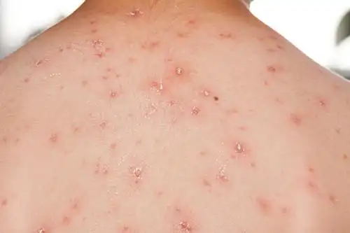 天一闷热皮肤就爱出现这些问题丨纪光伟