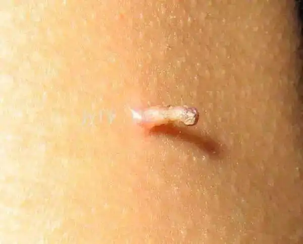 这些皮肤上长的"肉疙瘩",你知道是啥吗?