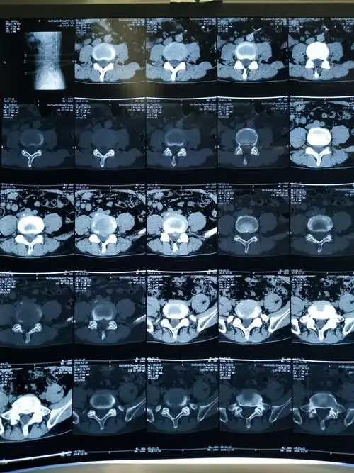腰椎ct示:腰4-5椎间盘突出(左旁中央型),腰5-骶1椎间盘突出(中央型)