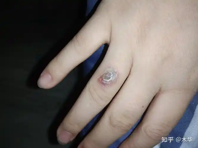 初中的时候手指长了个小瘊子不注意现在上大学了越长越大