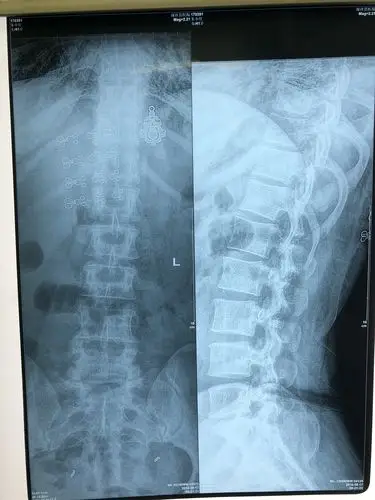 腰椎间盘突出微创治疗术中症状消失! - 好大夫在线