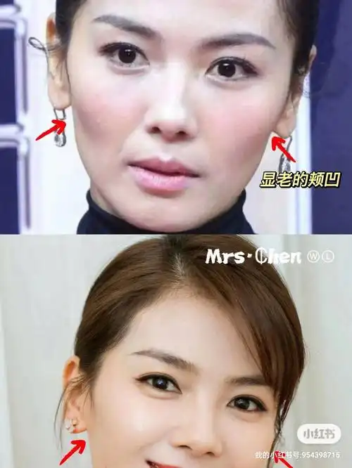 解决方式可以不同①缺失性凹陷:两颊凹陷 显颧骨突出 面中部扁平主要