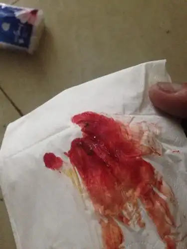 有点怕,请问是怎么回事?痔疮么?