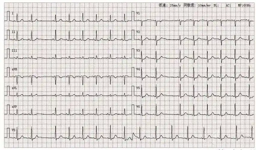 图库丨心电图系列房性早搏