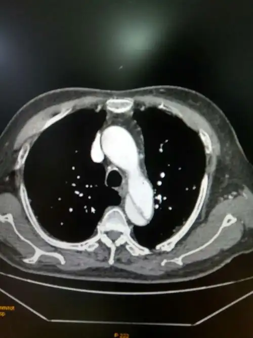 非心源性胸痛之主动脉夹层介入治疗病例汇报