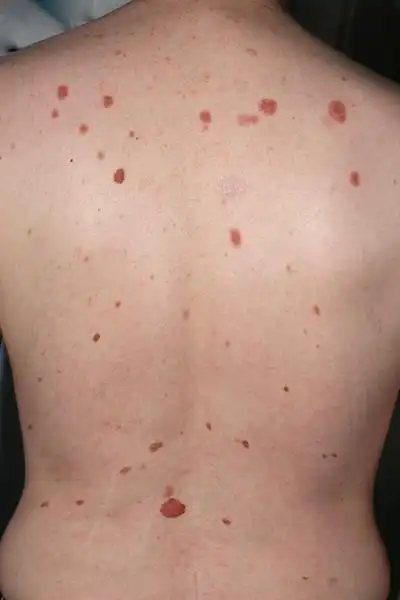 容易癌变的黑痣图片 (59)