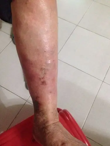 静脉曲张症状图片