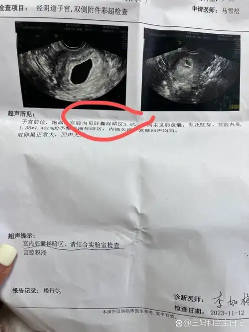 孕7周➕4⃣️没有卵黄囊 三无怀孕过程没有任何不适,孕6