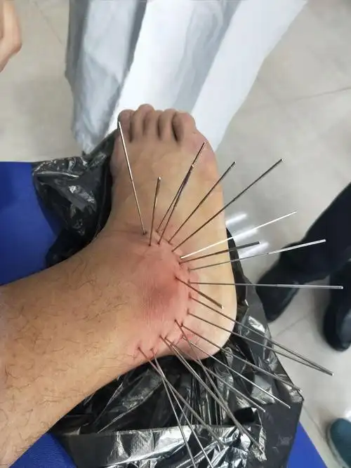 其它 中华内热针河南办事处 写美篇济宁佳科内热式针灸治疗仪,住河南