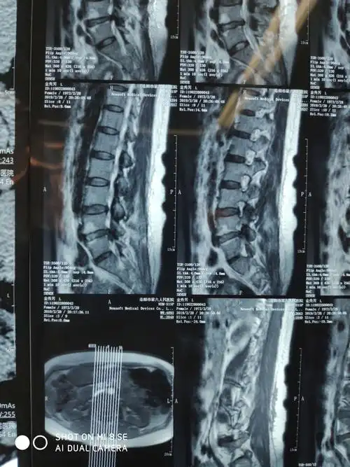 一例脱垂型腰间盘突出症的经椎间孔镜手术