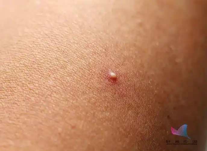 护健甄选后背长得小疙瘩到底是啥能不能去除