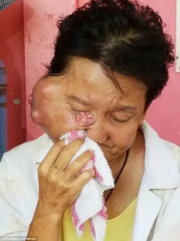 导致其面部一侧长出一个巨型肿瘤
