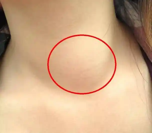 颈部肿块不可忽视