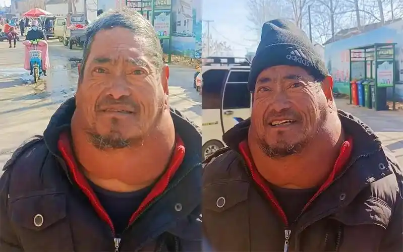 62岁大爷嗜酒成瘾得脂肪瘤一顿半斤酒,脖子肿成"派大星"