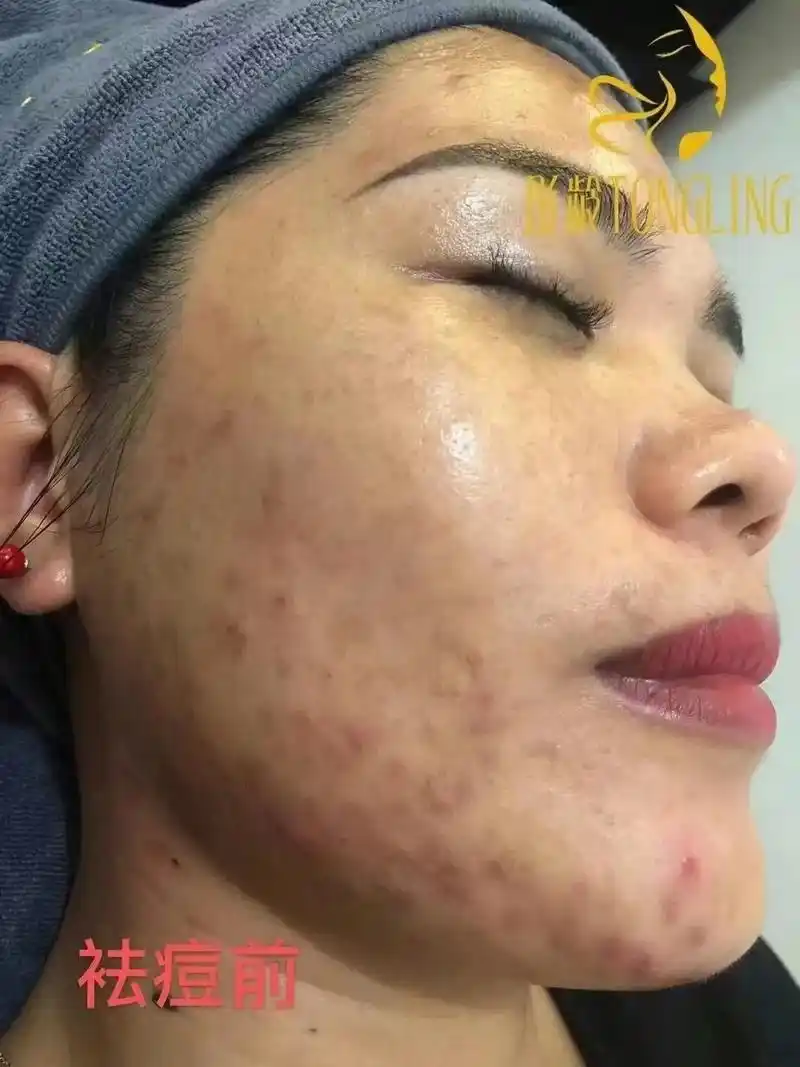袪痘,袪斑,袪痘印,3个月效果,客户说想不到自己的皮肤也能有 - 抖音