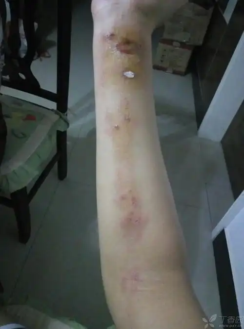 右前臂屈侧皮损(貌似沿肌腱走行) [病例帖]