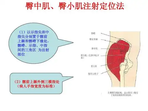 小肌注射定位法 (1)以示指尖和中 指尖分别置于髂前 上棘和髂嵴下缘处
