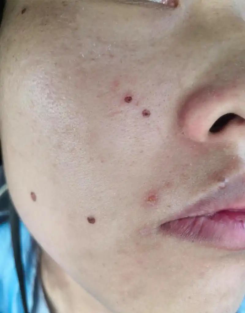 激光点痣不小心把结痂碰掉了,怎么处理?  别慌!