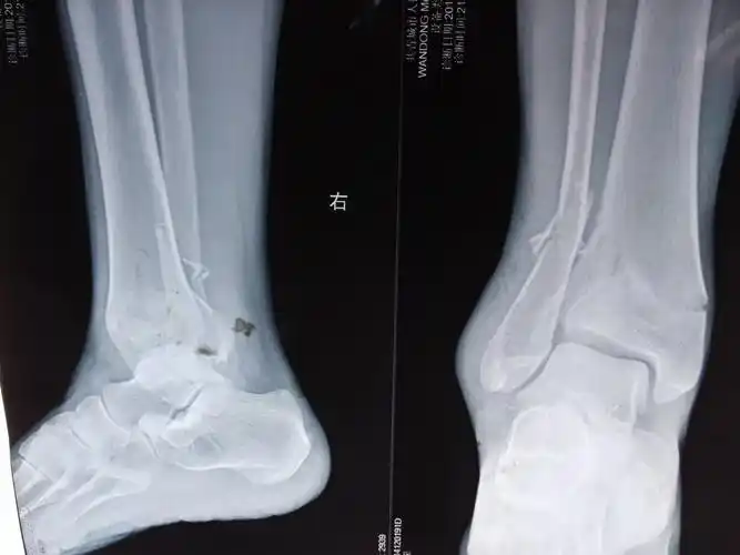 左胫腓骨远端粉碎性骨折
