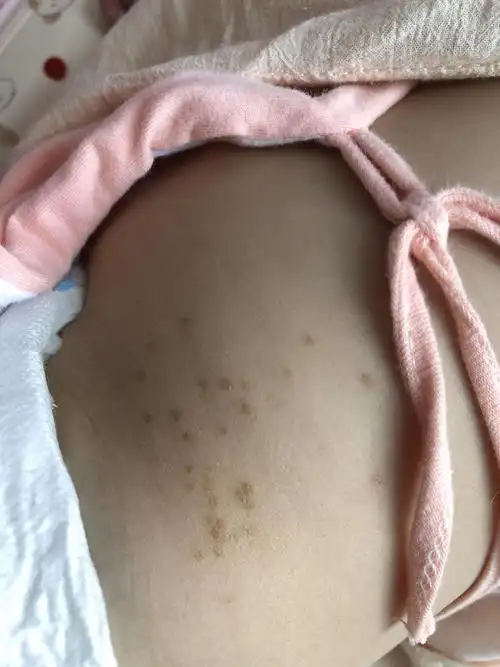 宝宝身上起了红疙瘩擦药好了,变成褐色的小疙瘩怎么办