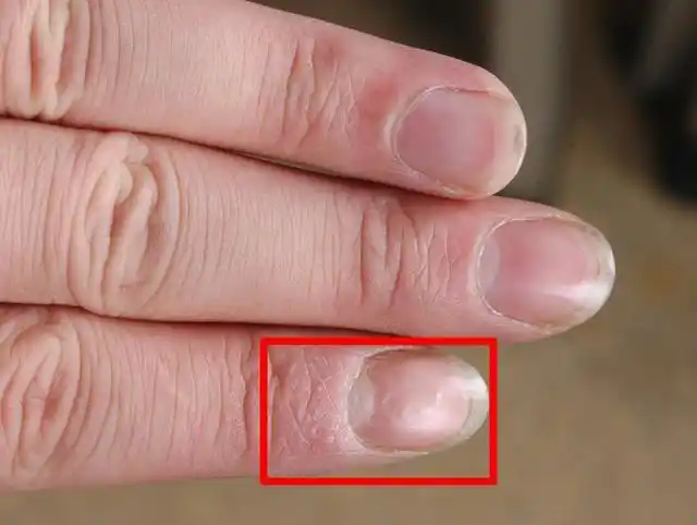 宝宝指甲凹凸不平咋回事宝宝指甲凹凸不平怎么回事