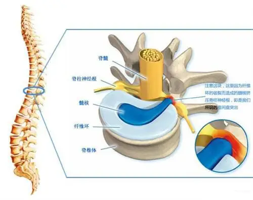 椎间盘1.jpg