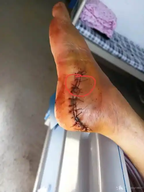 跟骨粉碎性骨折外侧l切口术后4天伤口引流条处少许分泌物渗出不愈可能