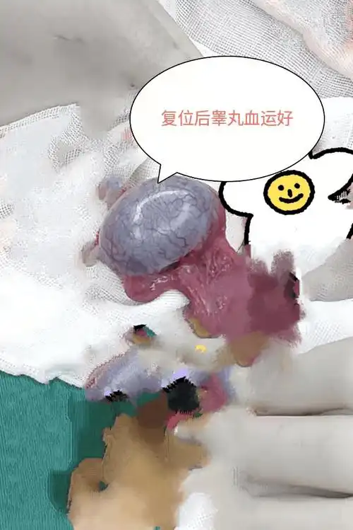 德庆一名14岁男孩"蛋蛋"扭转超过180°,医生马上急诊手术_睾丸_阴囊