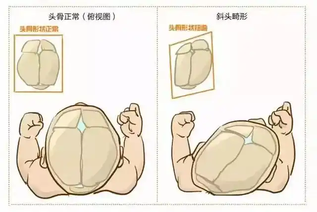让宝宝不再头部畸形!如何睡出完美头型,这些知识要知道