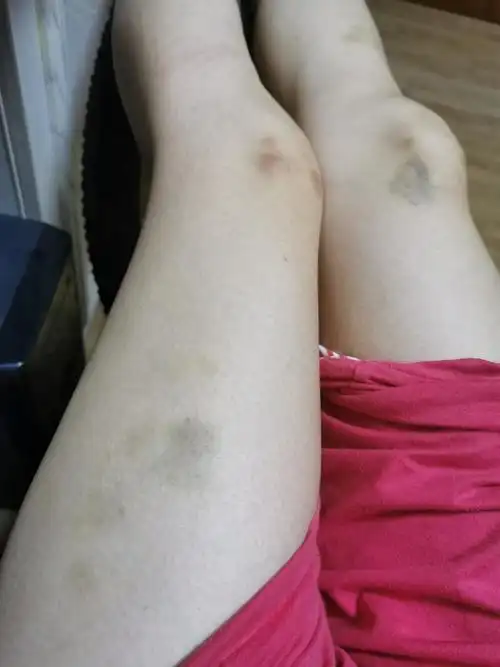 [慎入]有和我一样是淤青大户的jm嘛