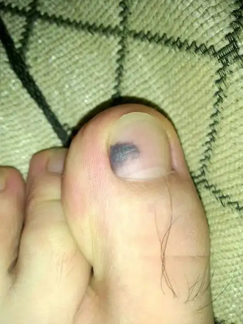 半个月莫名其妙左脚大拇指指甲下长出来一块黑色的东西,如下图,不记得
