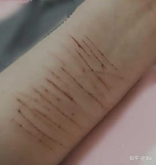 自残的人真的很令人讨厌吗?