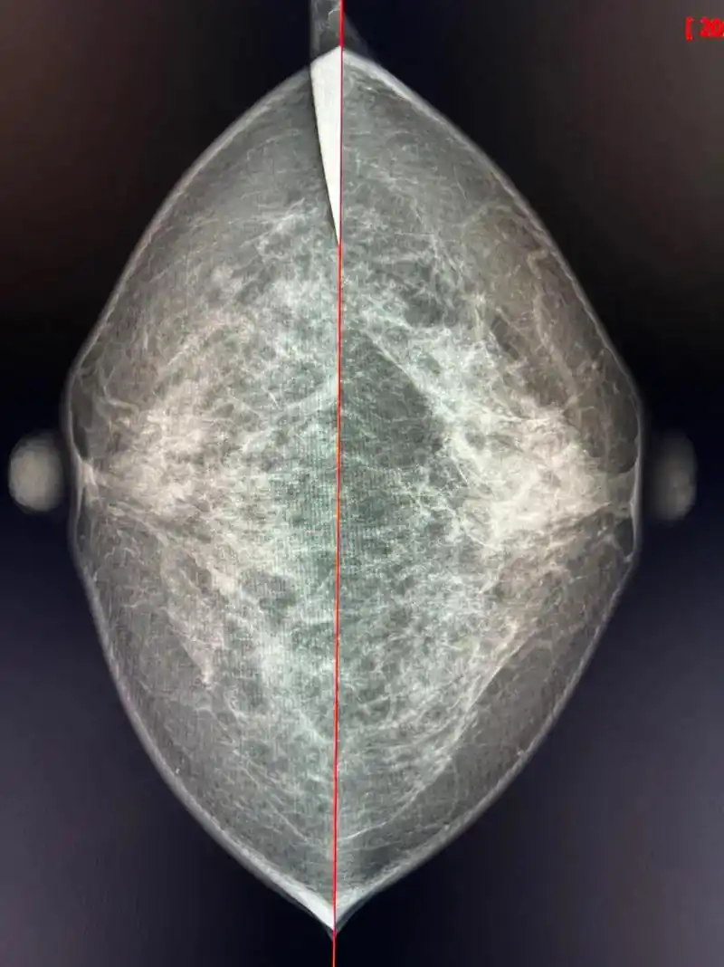 #影像大医生#医学影像 #钼靶检查 #乳腺不对称致密 #4a - 抖音