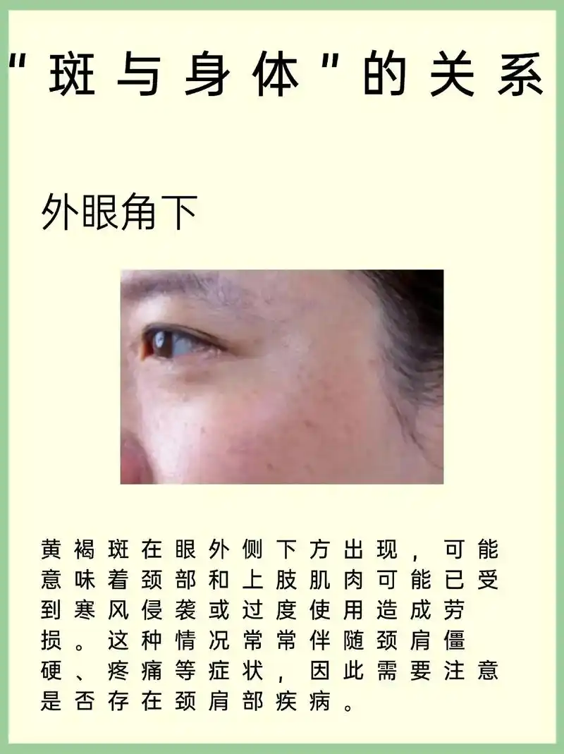 斑点不只长在脸上,查看你的身体健康状况.