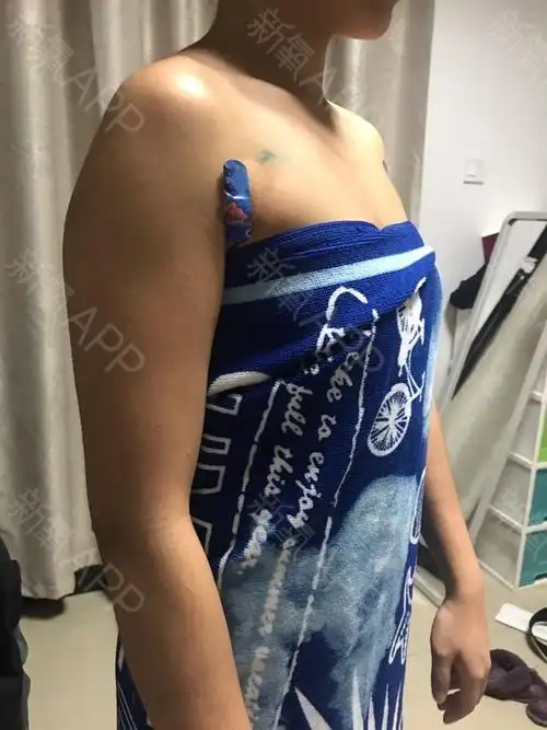 而且腿上的伤口当时也没怎么恢复好.所以医生说先不拆腿上的线.