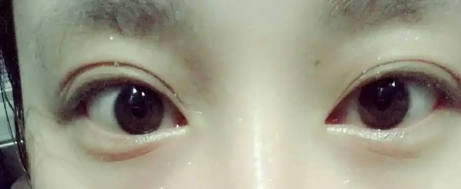 看,宝宝眼睛下面的一条线,那是什么?