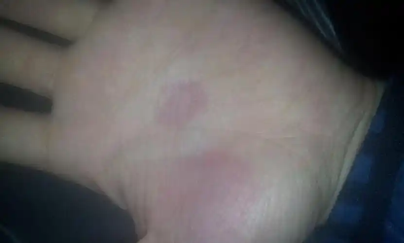 手心里的空心圆圈是什么病?是不是过敏还是别的呢?