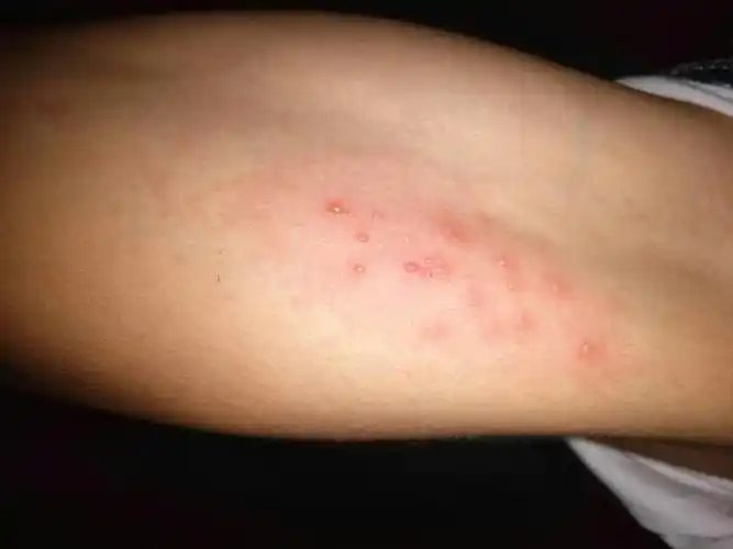 胳膊肘内侧又一片小水泡,很痒,让人抓狂,这是怎么了,是疱疹吗严重吗?