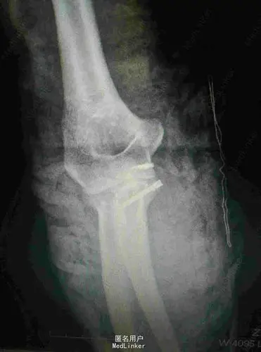 尺骨冠状突骨折