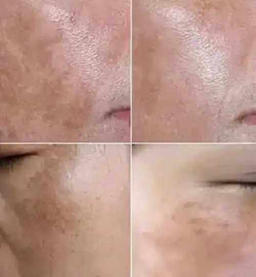 是一种后天性局限性色素增多疾病,又称蝴蝶斑,妊娠斑,肝斑等,这几种是