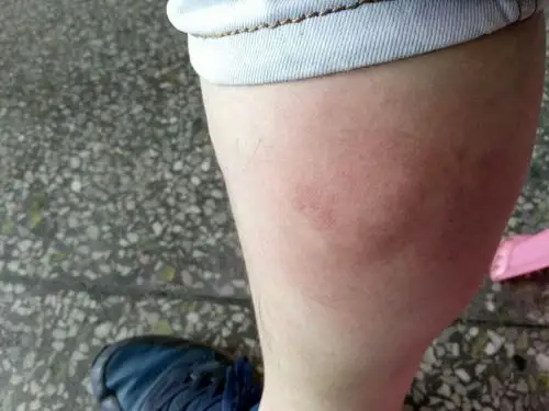 小腿血管突出明显,出现疼痛!