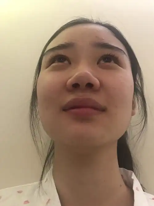我我的鼻子在没做之前是非常难看的比量,他鼻子扁平显_圈子-新氧美容